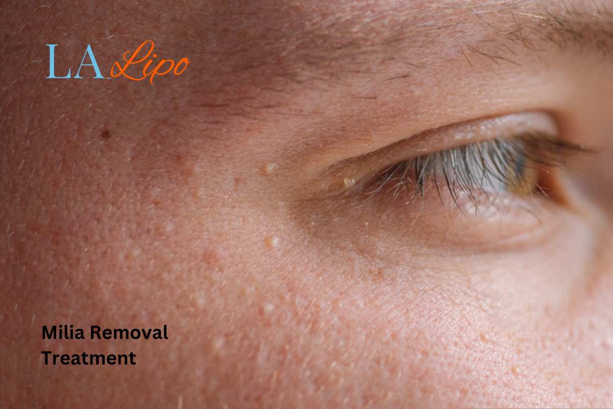 Cryopen Milia Removal: Is It the Easiest and Safest Option Hastings?