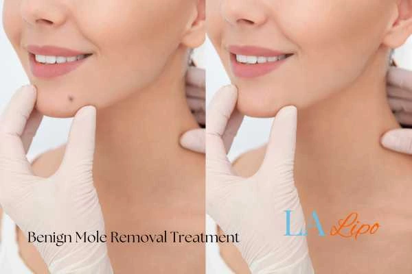 woman's before and after mole removal Hastings results