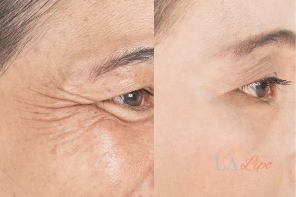Before and after results of woman - HI-fu wrinkles reduction treatment Hastings