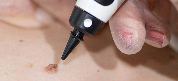 skin tag removal using cryopen Hastings