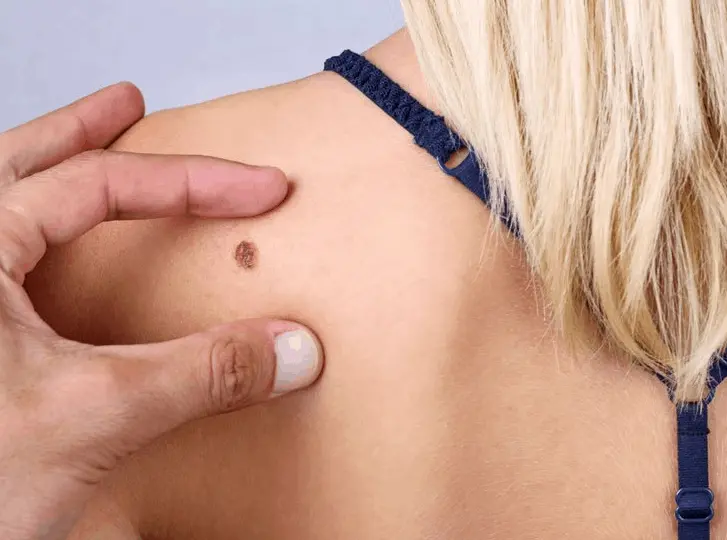 woman having mole removal Hastings consultation before treatment.