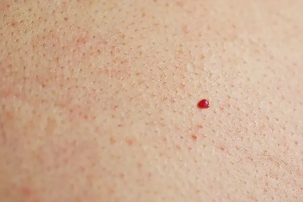 close up of a cherry angioma Hastings