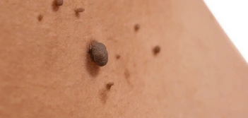 image of a skin tag Hastings