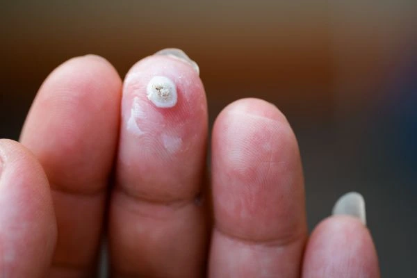 wart on person finger - cryotherapy to treat from LA LIPO Hastings