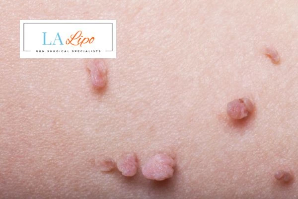 Does cryopen skin tag removal Hastings hurt? Find out now call our team today!