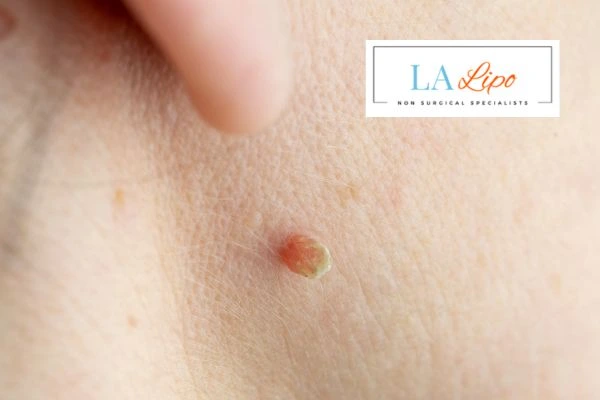 Book skin tag removal Hastings today speak to our team now!