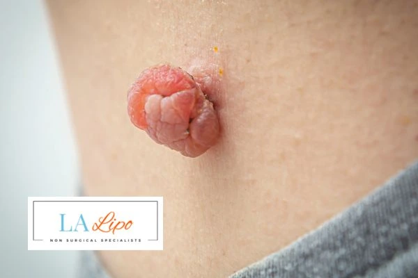 Interested in skin tag removal Hastings? Concerned about the pain? Find out more today!