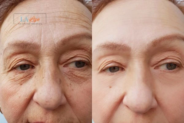The powerful benefits of Morpheus8 Treatment Hastings - Call Our team today!