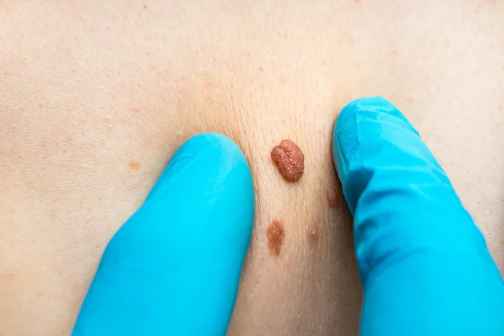 LA LIPO Cryopen Lesion Removal Prices Hastings