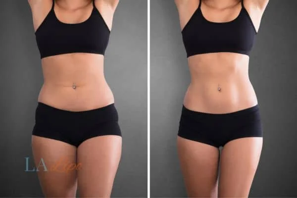 before and after results of non-surgical treatment to help a woman's body image and mental health Hastings
