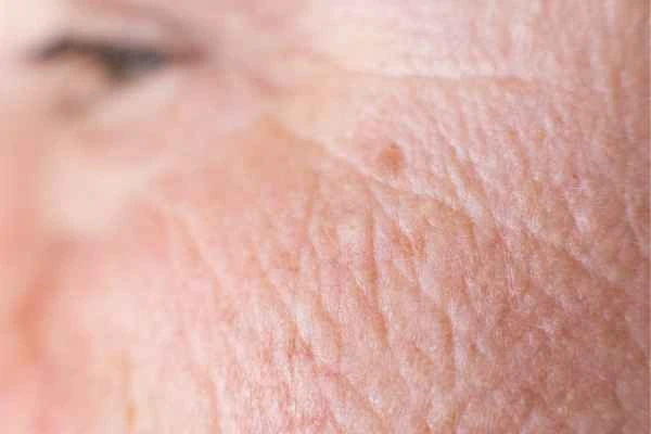close up picture of a woman's face showing an age spot Hastings