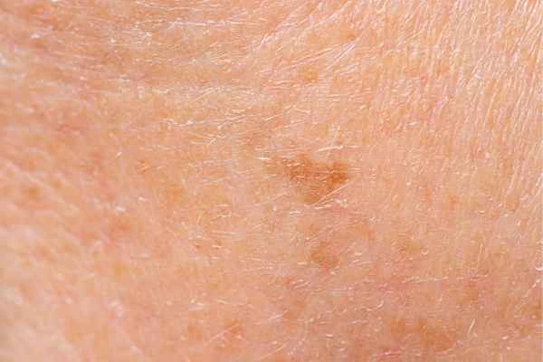 close up picture of age spots Hastings
