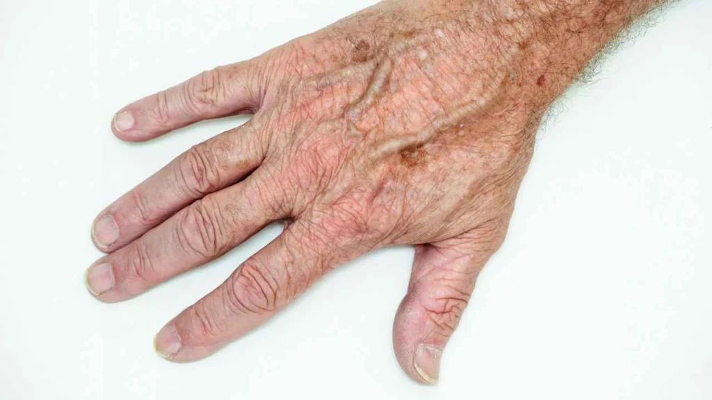 Male hand showing age spot Hastings