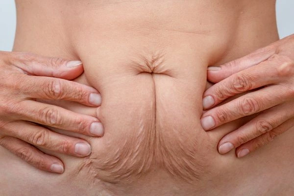 Image of a woman's stomach with loose skin - example of skin tightening Hastings options